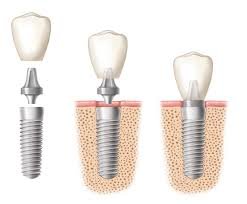 schéma implant dentaire
